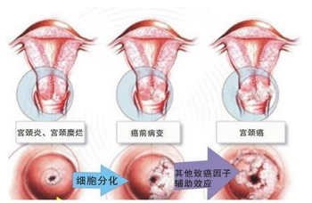 "宫颈糜烂"不可怕，不是病！